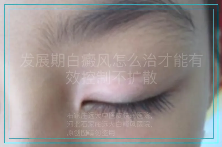 发展期白癜风怎么治才能有效控制不扩散