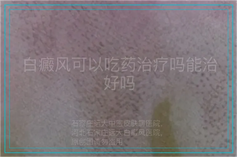 白癜风可以吃药治疗吗能治好吗