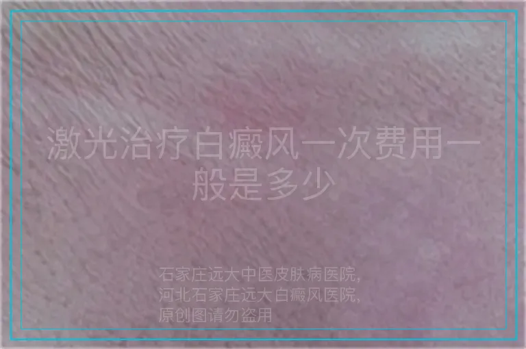 激光治疗白癜风一次费用一般是多少