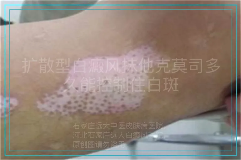 扩散型白癜风抹他克莫司多久能控制住白斑