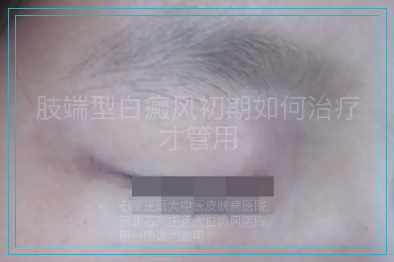 肢端型白癜风初期如何治疗才管用