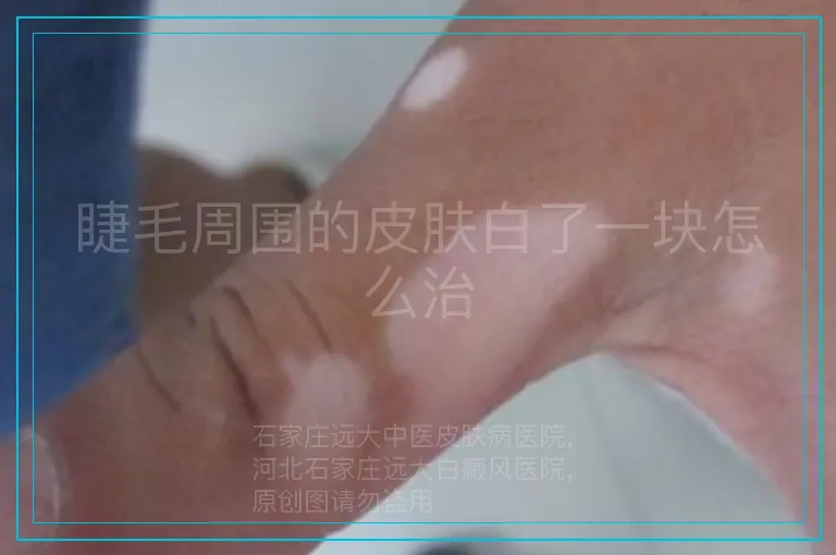 睫毛周围的皮肤白了一块怎么治