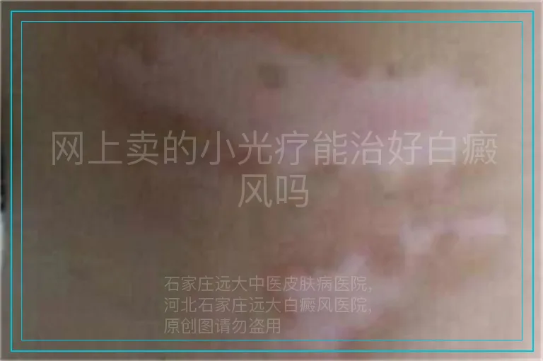 网上卖的小光疗能治好白癜风吗