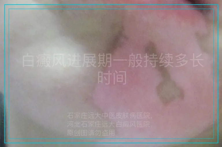白癜风进展期一般持续多长时间