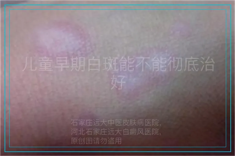儿童早期白斑能不能彻底治好