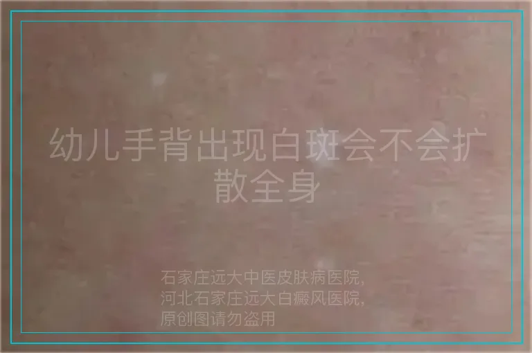 幼儿手背出现白斑会不会扩散全身