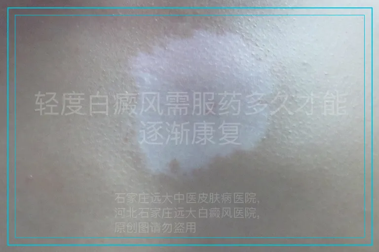 轻度白癜风需服药多久才能逐渐康复