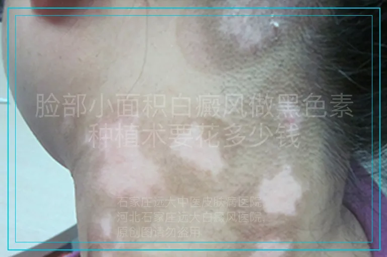 脸部小面积白癜风做黑色素种植术要花多少钱