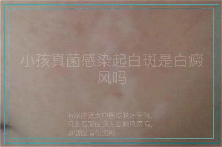 小孩真菌感染起白斑是白癜风吗