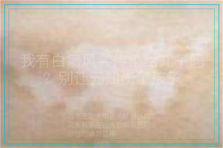 我有白癜风会传染给儿子吗?别让无知伤了孩子