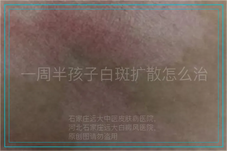 一周半孩子白斑扩散怎么治