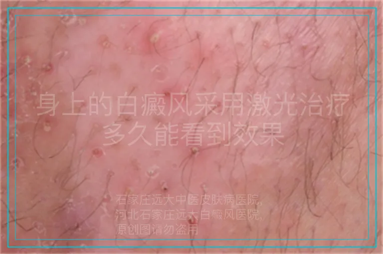 身上的白癜风采用激光治疗多久能看到效果
