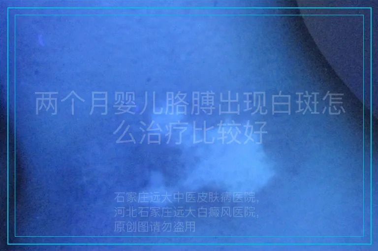 两个月婴儿胳膊出现白斑怎么治疗比较好