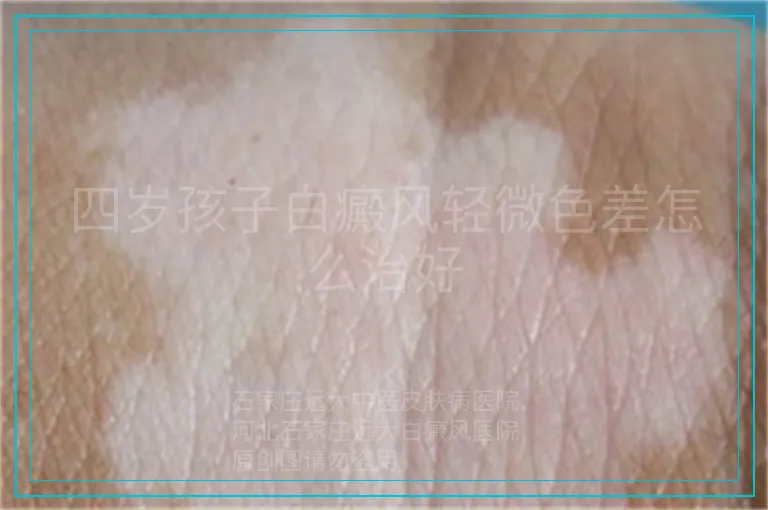 四岁孩子白癜风轻微色差怎么治好