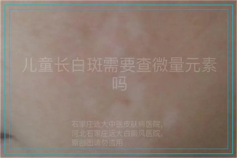 儿童长白斑需要查微量元素吗