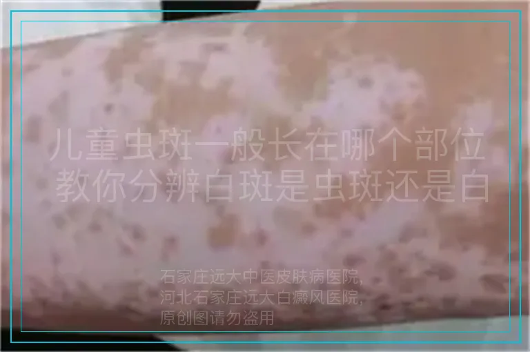 儿童虫斑一般长在哪个部位 教你分辨白斑是虫斑还是白癜风