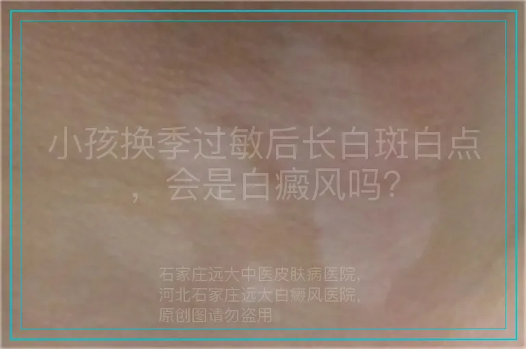 小孩换季过敏后长白斑白点,会是白癜风吗?