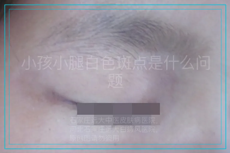 小孩小腿白色斑点是什么问题