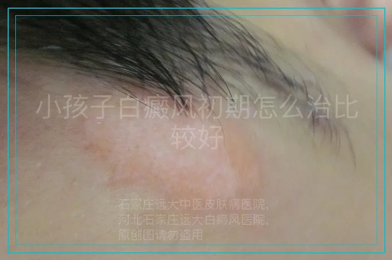 小孩子白癜风初期怎么治比较好