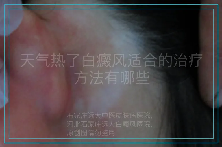 天气热了白癜风适合的治疗方法有哪些