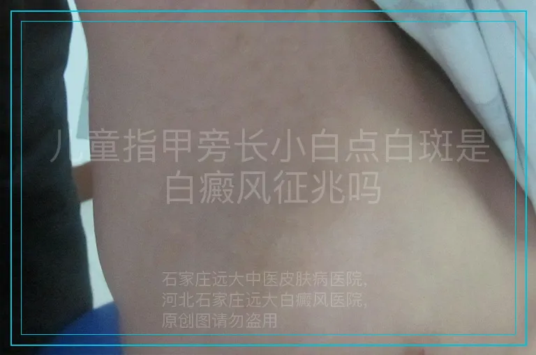 儿童指甲旁长小白点白斑是白癜风征兆吗