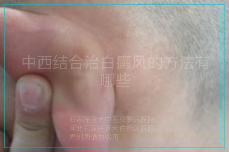 中西结合治白癜风的方法有哪些
