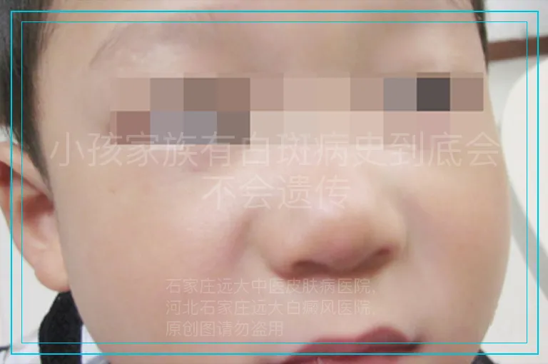 小孩家族有白斑病史到底会不会遗传