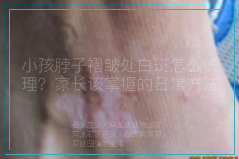 小孩脖子褶皱处白斑怎么护理?家长该掌握的日常方法