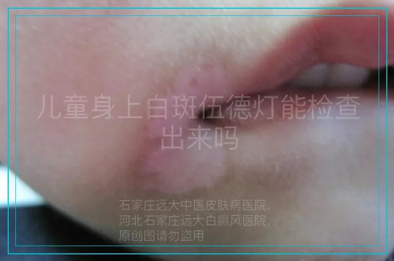 儿童身上白斑伍德灯能检查出来吗
