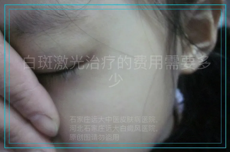 白斑激光治疗的费用需要多少