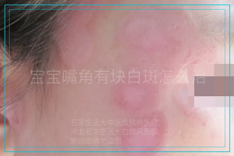 宝宝嘴角有块白斑怎么治
