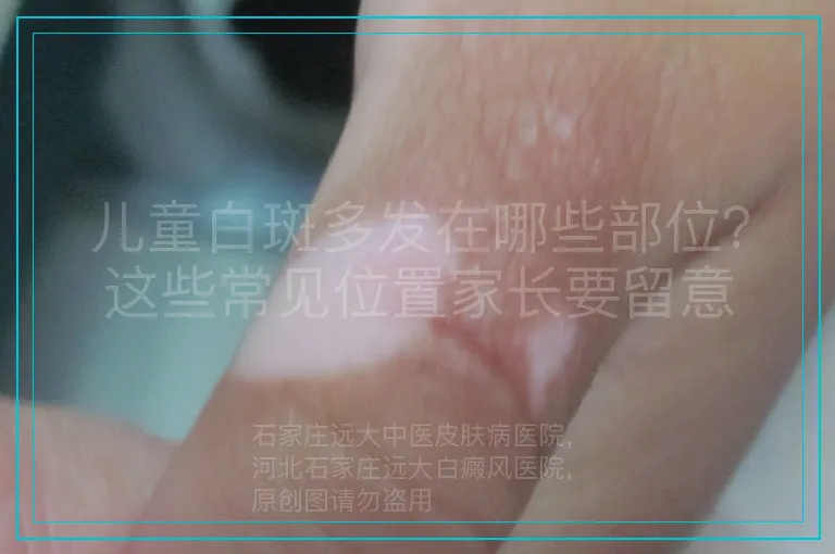 儿童白斑多发在哪些部位?这些常见位置家长要留意