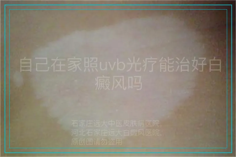 自己在家照uvb光疗能治好白癜风吗