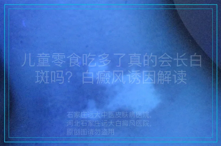 儿童零食吃多了真的会长白斑吗?白癜风诱因解读