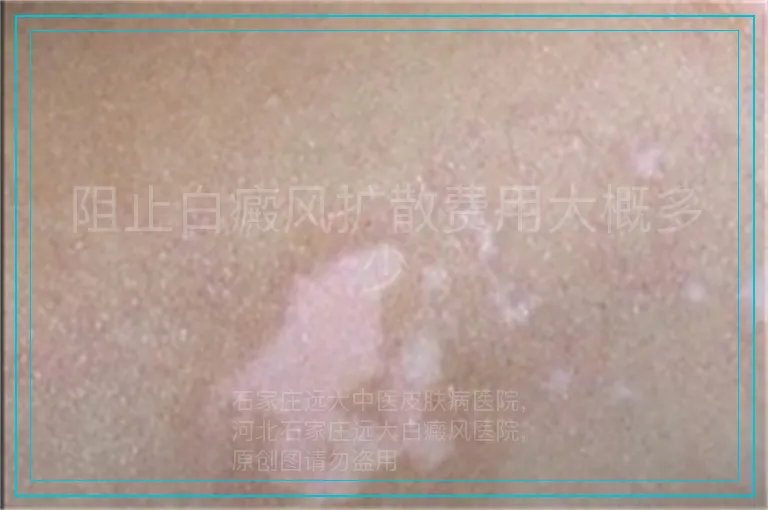 阻止白癜风扩散费用大概多少