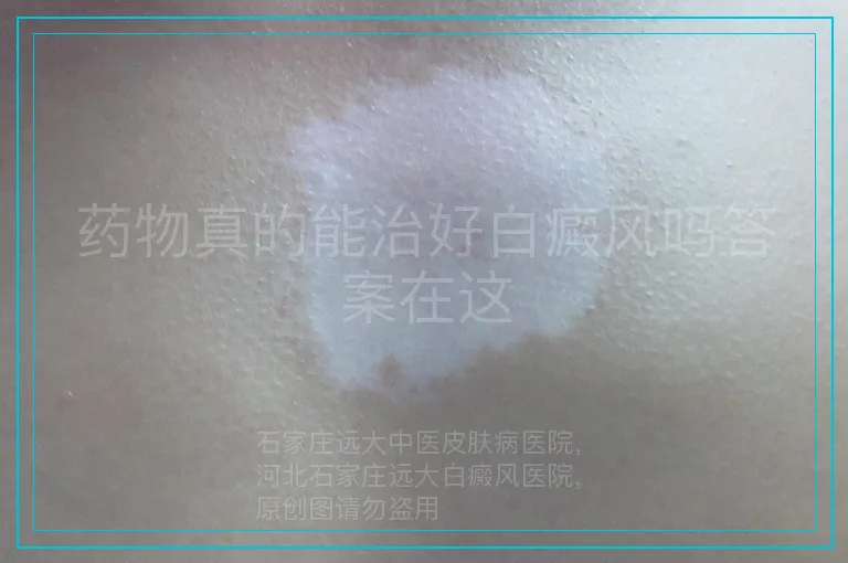 药物真的能治好白癜风吗答案在这