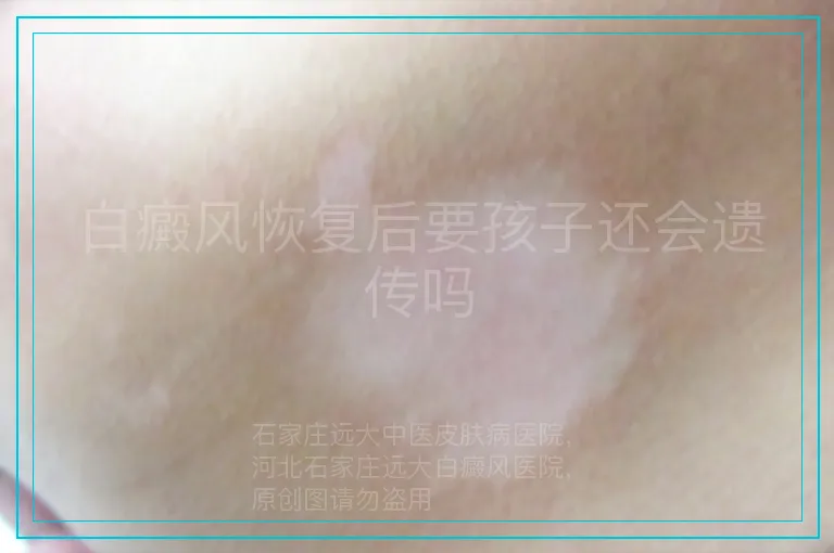 白癜风恢复后要孩子还会遗传吗