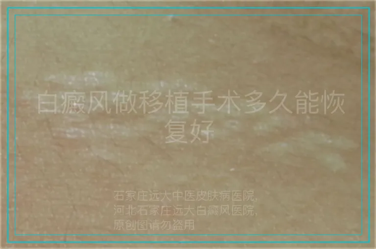 白癜风做移植手术多久能恢复好