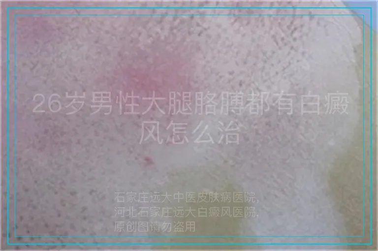 26岁男性大腿胳膊都有白癜风怎么治