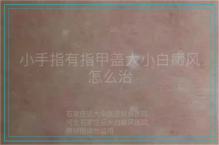 小手指有指甲盖大小白癜风怎么治