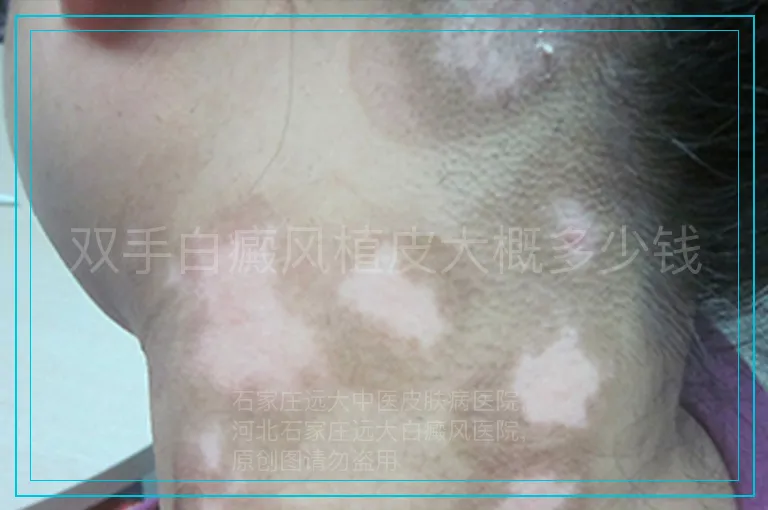 双手白癜风植皮大概多少钱