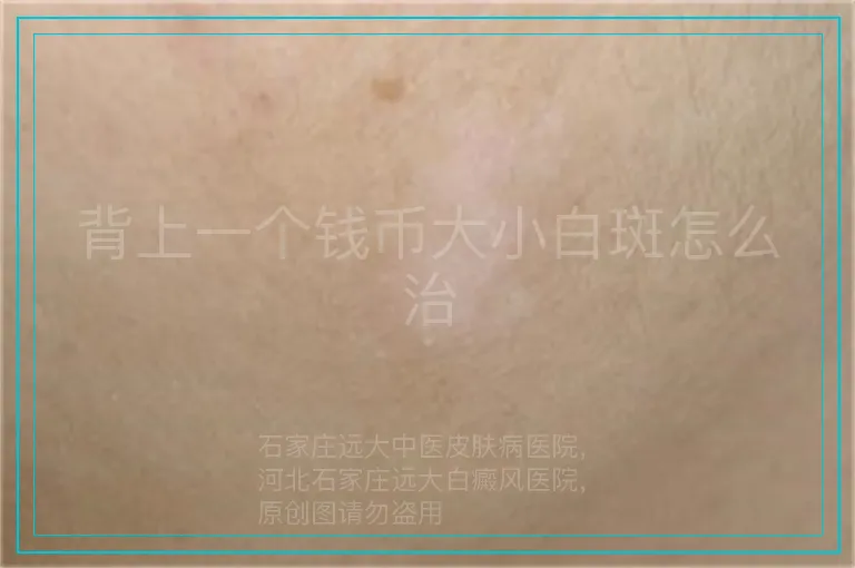 背上一个钱币大小白斑怎么治