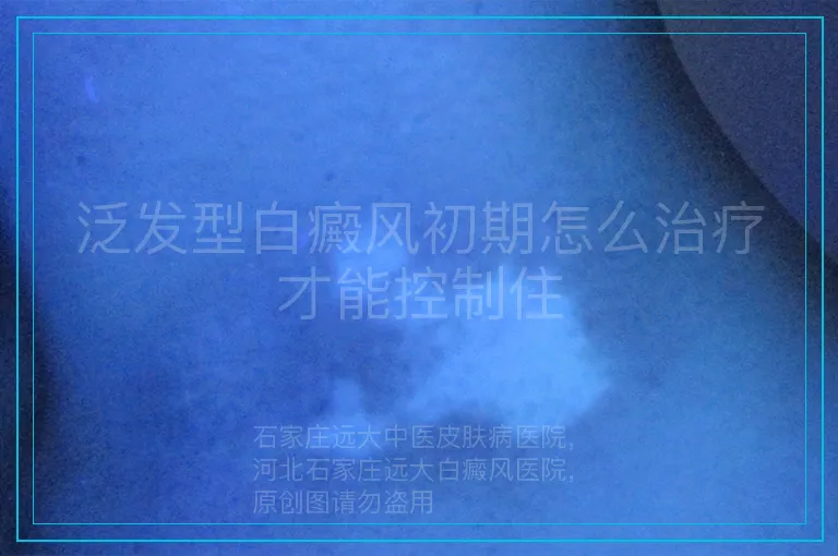 泛发型白癜风初期怎么治疗才能控制住