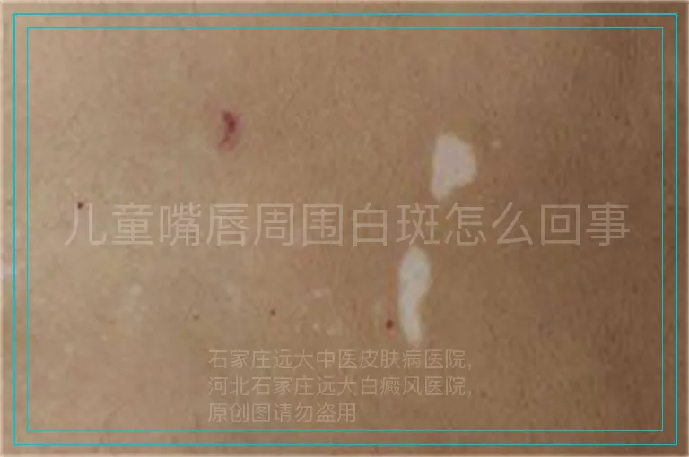儿童嘴唇周围白斑怎么回事