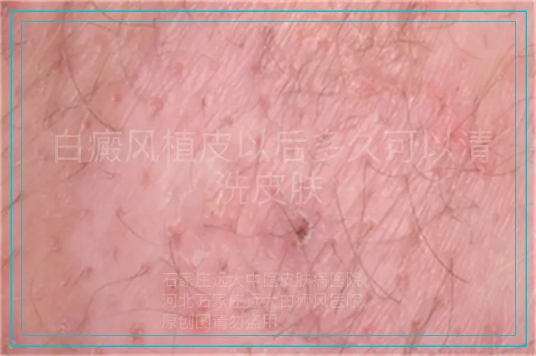 白癜风植皮以后多久可以清洗皮肤