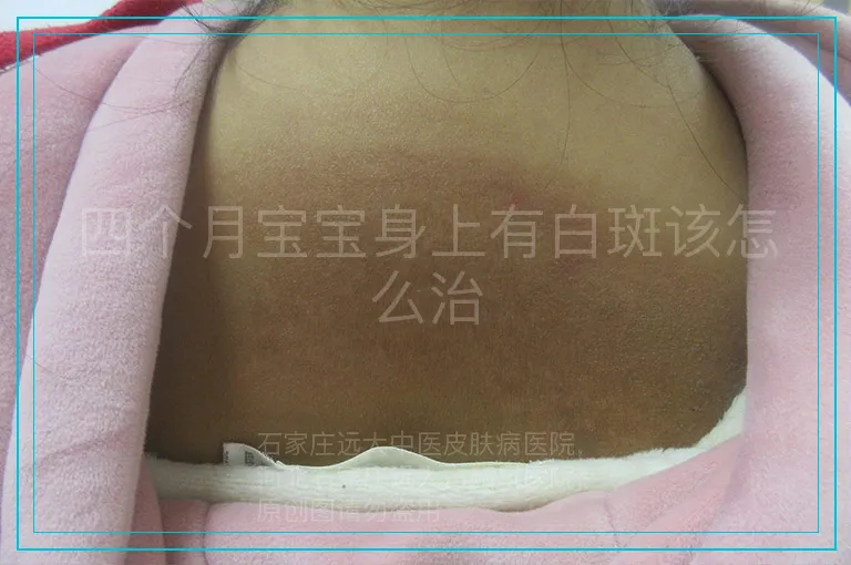 四个月宝宝身上有白斑该怎么治