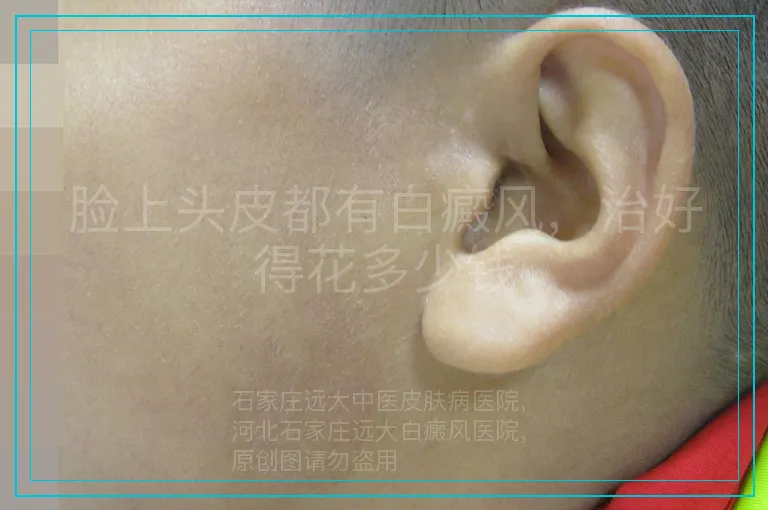 脸上头皮都有白癜风,治好得花多少钱