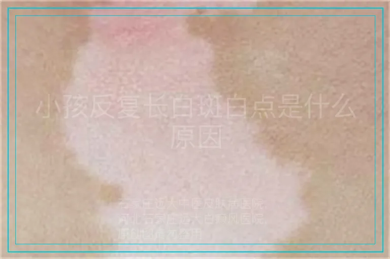 小孩反复长白斑白点是什么原因