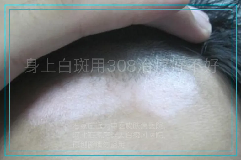 身上白斑用308治疗好不好