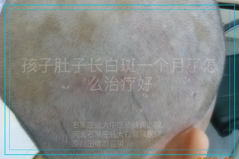 孩子肚子长白斑一个月了怎么治疗好